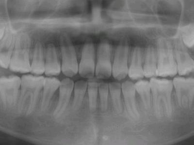 埋伏歯の矯正治療後口内写真NO.6