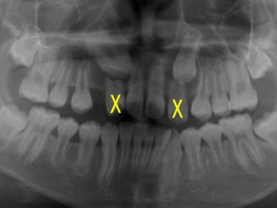 埋伏歯の矯正治療前口内写真NO.6