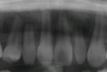 埋伏歯の矯正治療後口内写真NO.7
