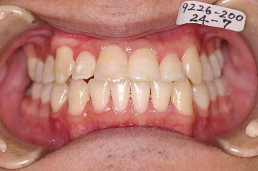 埋伏歯の矯正治療後口内写真NO.8