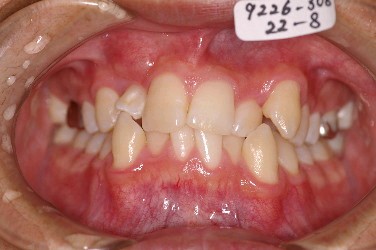 埋伏歯の矯正治療前口内写真NO.8