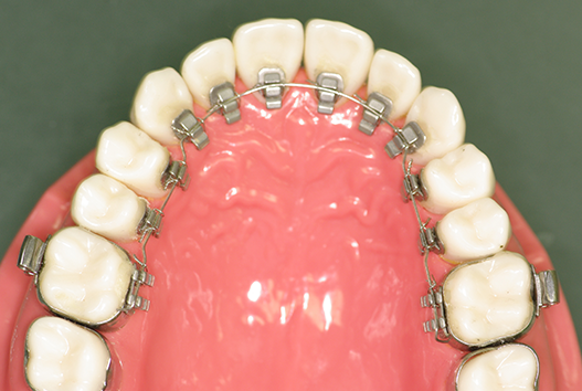 列 矯正 費用 子供 歯 子供の八重歯は小児矯正で治療するべき？原因やデメリットを解説