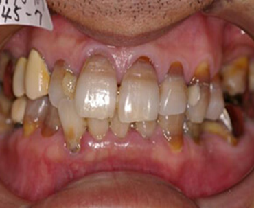 歯周病を伴うケースの矯正治療を終えた患者さんからの口コミ・感想