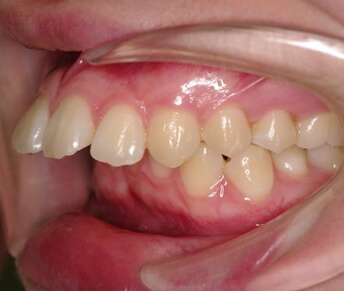 前歯、出っ歯・開咬矯正治療前の口内写真