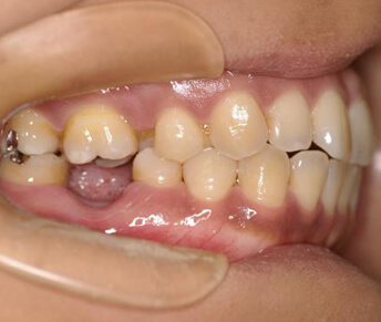 歯欠損矯正治療前の口内写真
