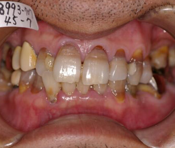歯周病を伴った矯正治療前の口内写真