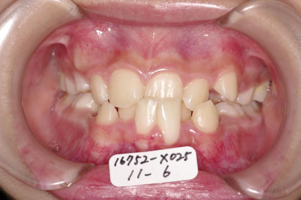 子供の矯正治療前口内写真NO.40