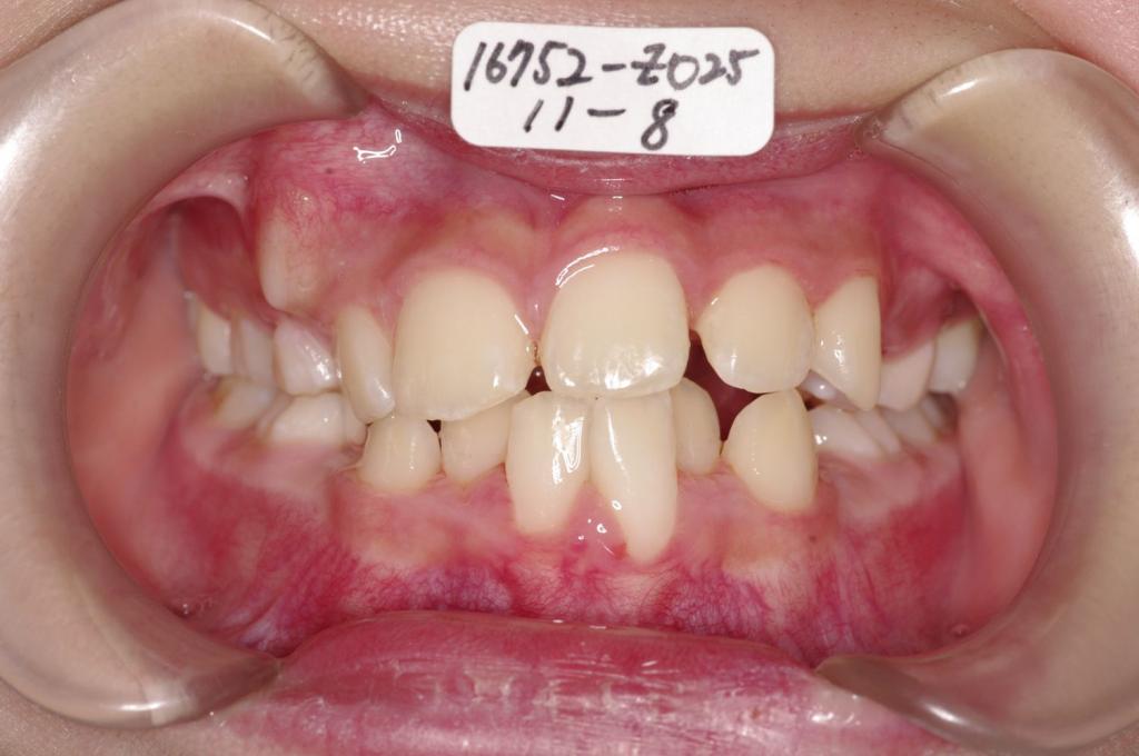子供の矯正治療後口内写真NO.40