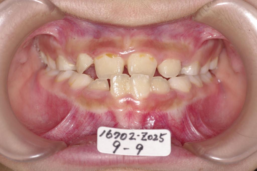 子供の矯正治療前口内写真NO.41