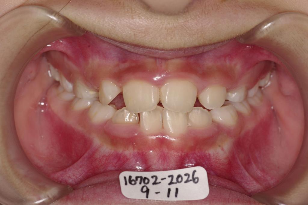 子供の矯正治療後口内写真NO.41