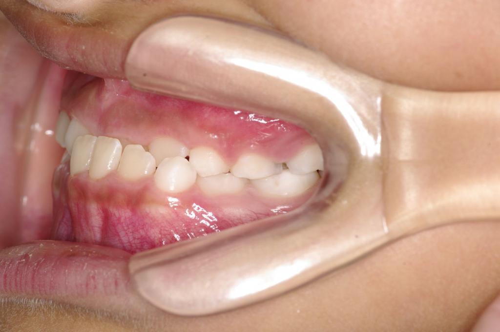 子供の矯正治療前口内写真NO.42