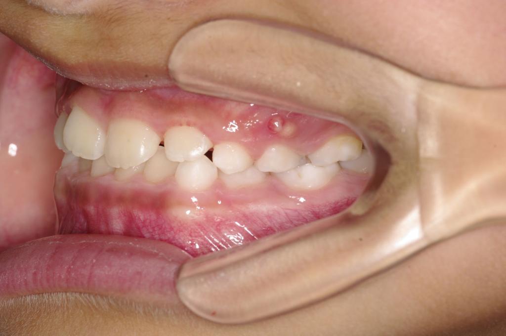 子供の矯正治療後口内写真NO.42