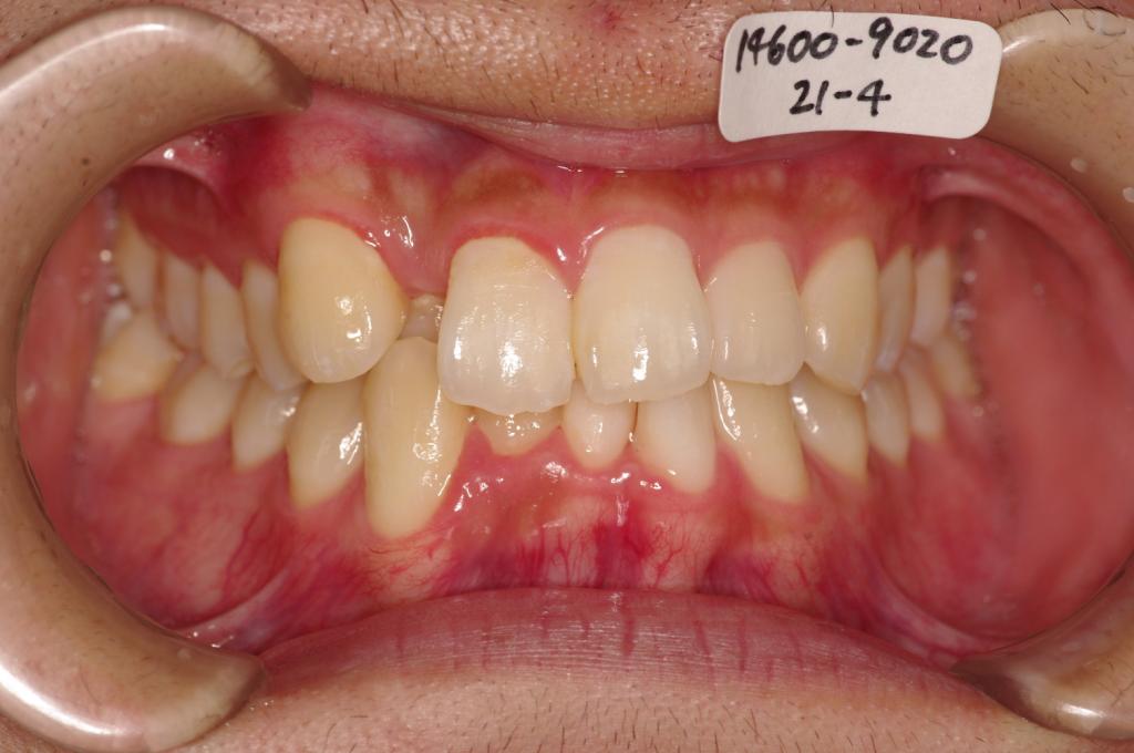 歯並び・咬み合わせ・八重歯・乱杭歯の矯正治療前口内写真NO.1090
