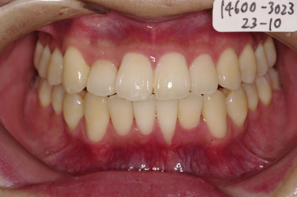 歯並び・咬み合わせ・八重歯・乱杭歯の矯正治療後口内写真NO.1090