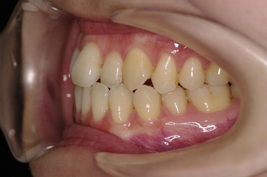 歯並び・咬み合わせ・八重歯・乱杭歯の矯正治療前口内写真NO.1091