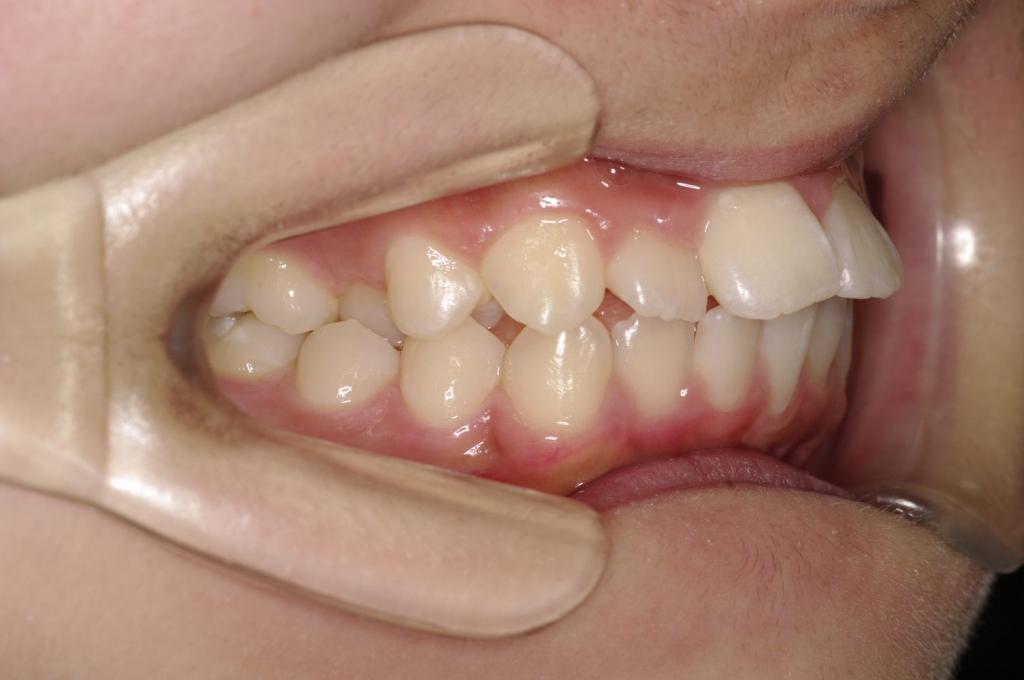 歯並び・咬み合わせ・八重歯・乱杭歯の矯正治療前口内写真NO.1092