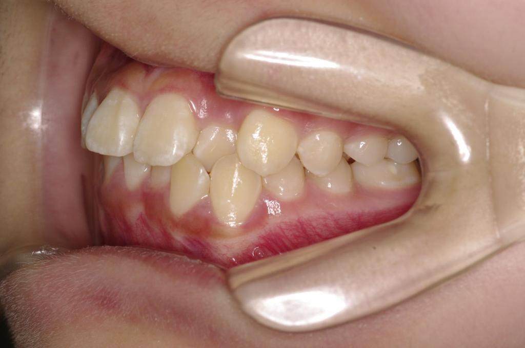 歯並び・咬み合わせ・八重歯・乱杭歯の矯正治療前口内写真NO.1093