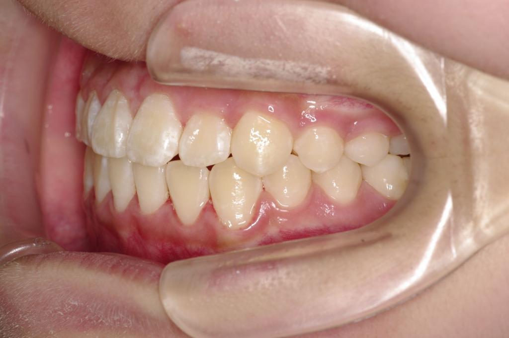 歯並び・咬み合わせ・八重歯・乱杭歯の矯正治療後口内写真NO.1093