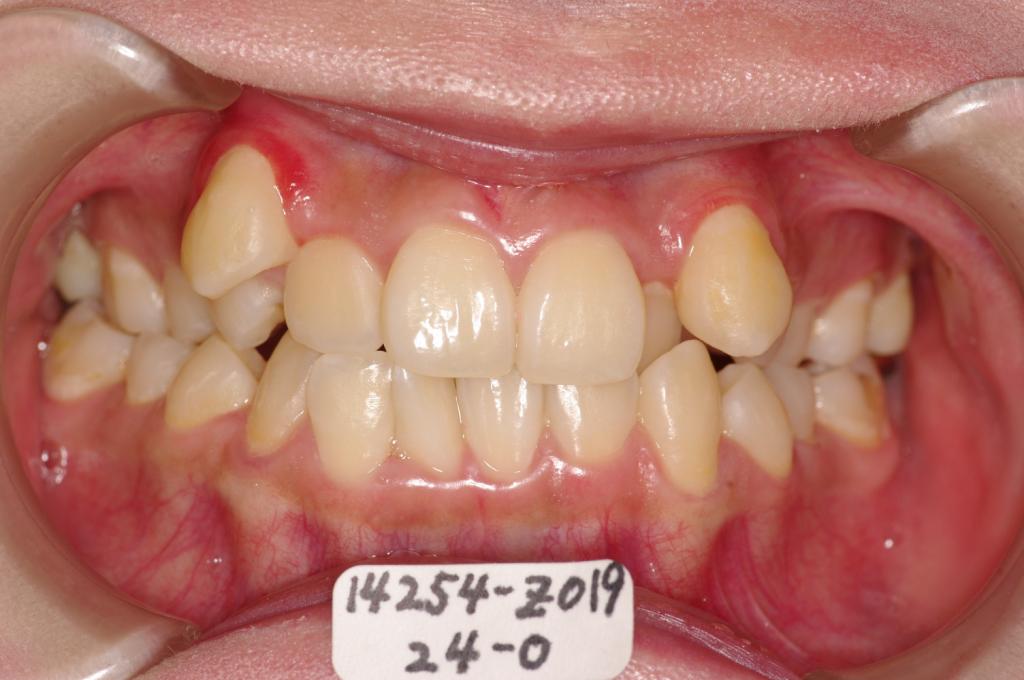 歯並び・咬み合わせ・八重歯・乱杭歯の矯正治療前口内写真NO.1094