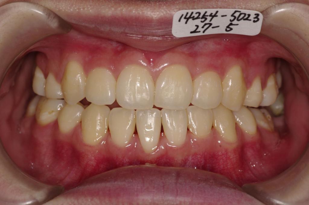 歯並び・咬み合わせ・八重歯・乱杭歯の矯正治療後口内写真NO.1094