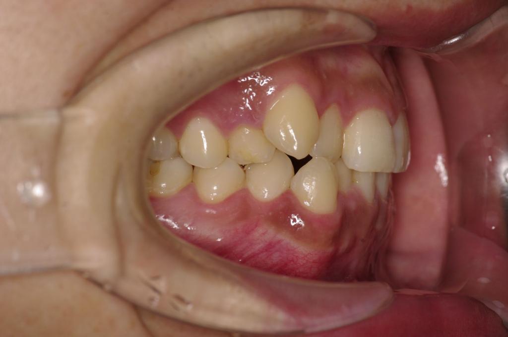歯並び・咬み合わせ・八重歯・乱杭歯の矯正治療前口内写真NO.1095