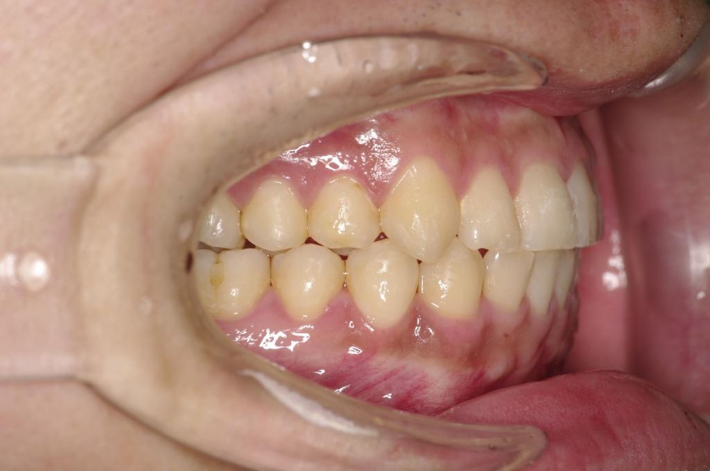歯並び・咬み合わせ・八重歯・乱杭歯の矯正治療後口内写真NO.1095