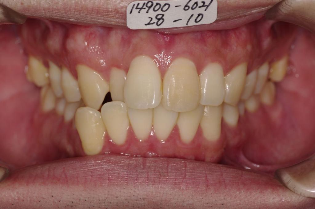 歯並び・咬み合わせ・八重歯・乱杭歯の矯正治療前口内写真NO.1096