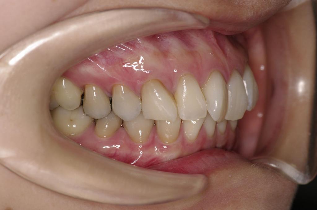 歯並び・咬み合わせ・八重歯・乱杭歯の矯正治療前口内写真NO.1097