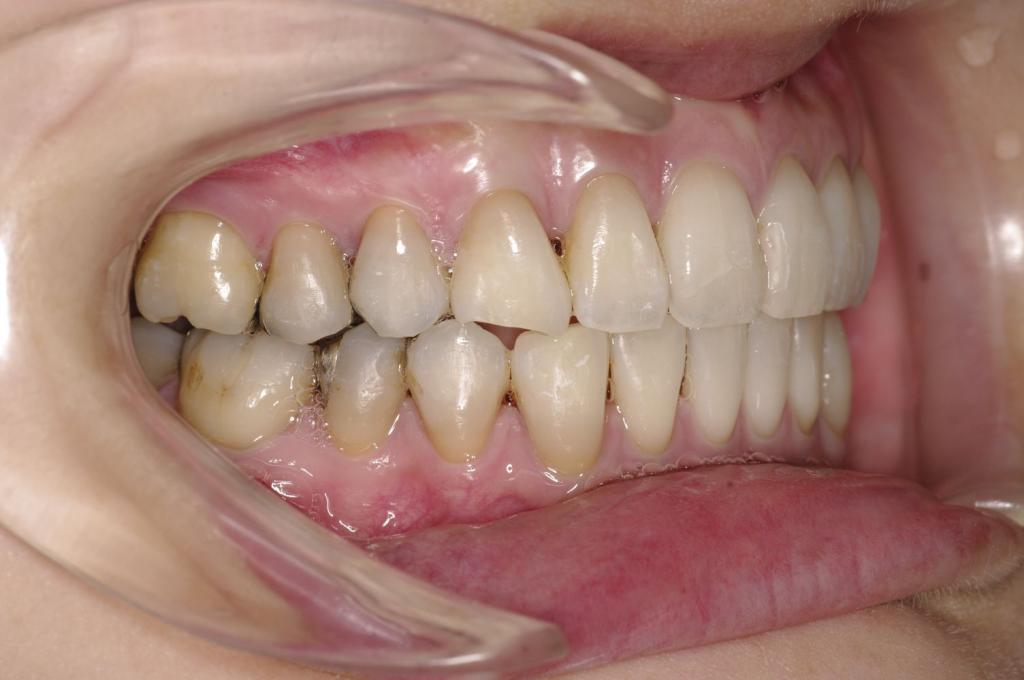 歯並び・咬み合わせ・八重歯・乱杭歯の矯正治療後口内写真NO.1097