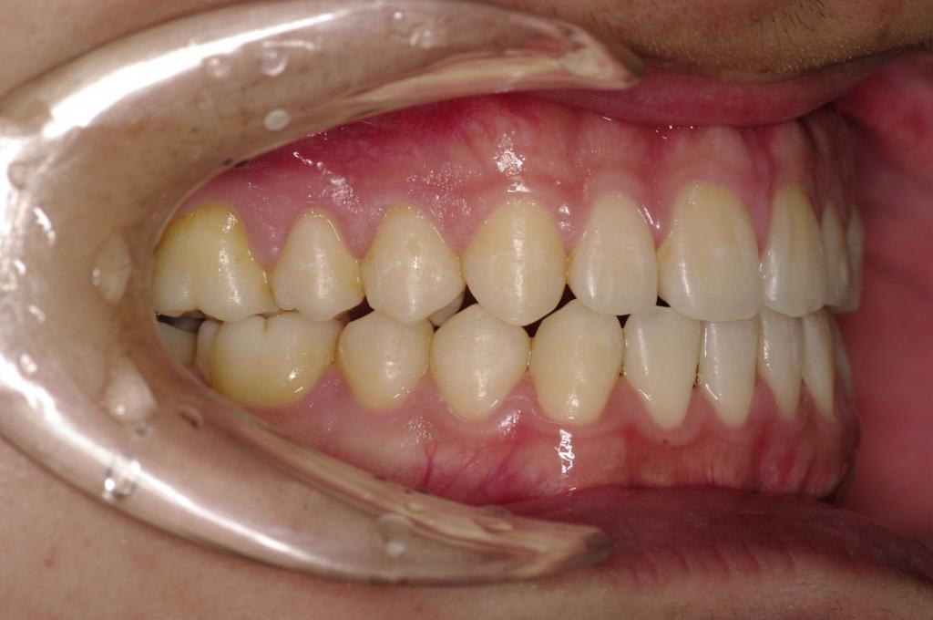歯並び・咬み合わせ・八重歯・乱杭歯の矯正治療後口内写真NO.1098