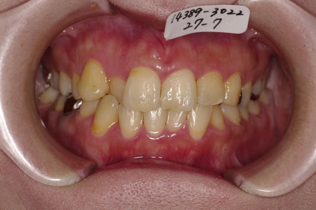 歯並び・咬み合わせ・八重歯・乱杭歯の矯正治療前口内写真NO.1099