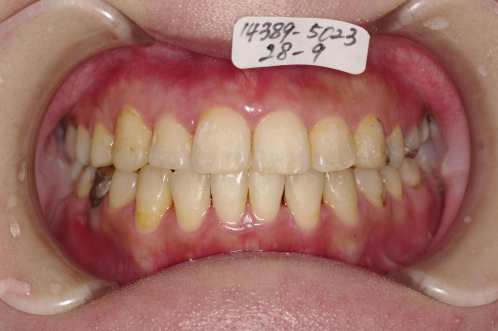 歯並び・咬み合わせ・八重歯・乱杭歯の矯正治療後口内写真NO.1099