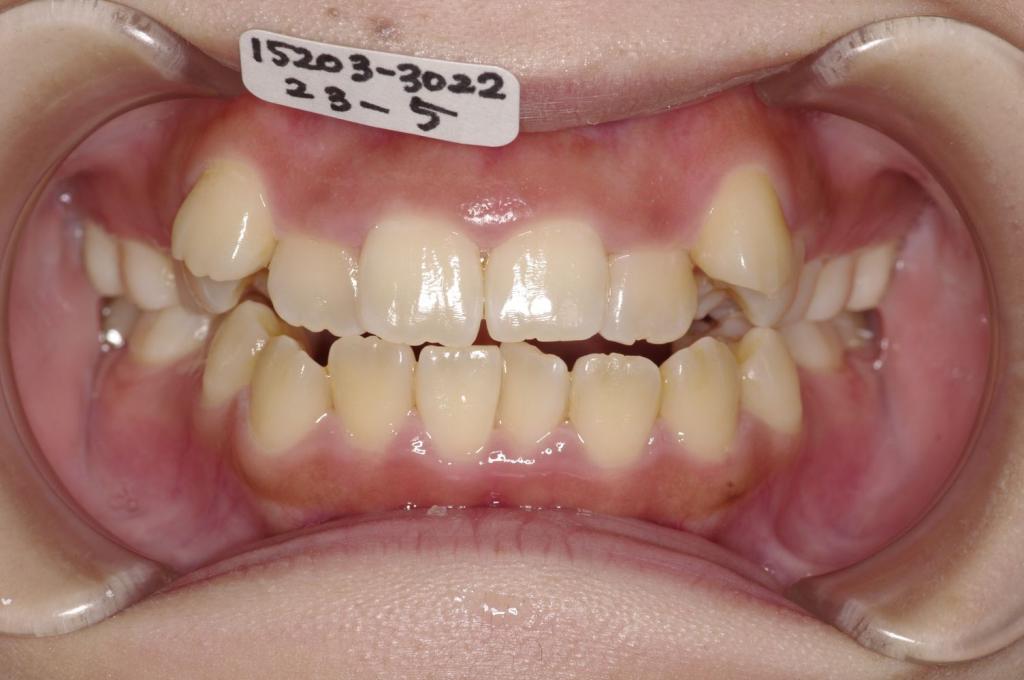 歯並び・咬み合わせ・八重歯・乱杭歯の矯正治療前口内写真NO.1121