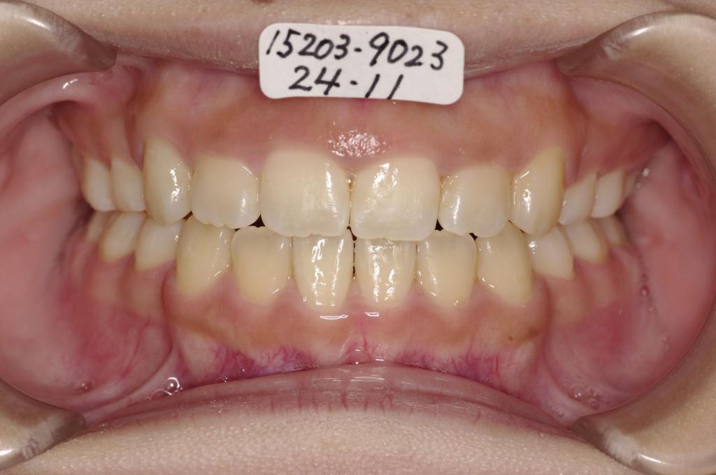 歯並び・咬み合わせ・八重歯・乱杭歯の矯正治療後口内写真NO.1121