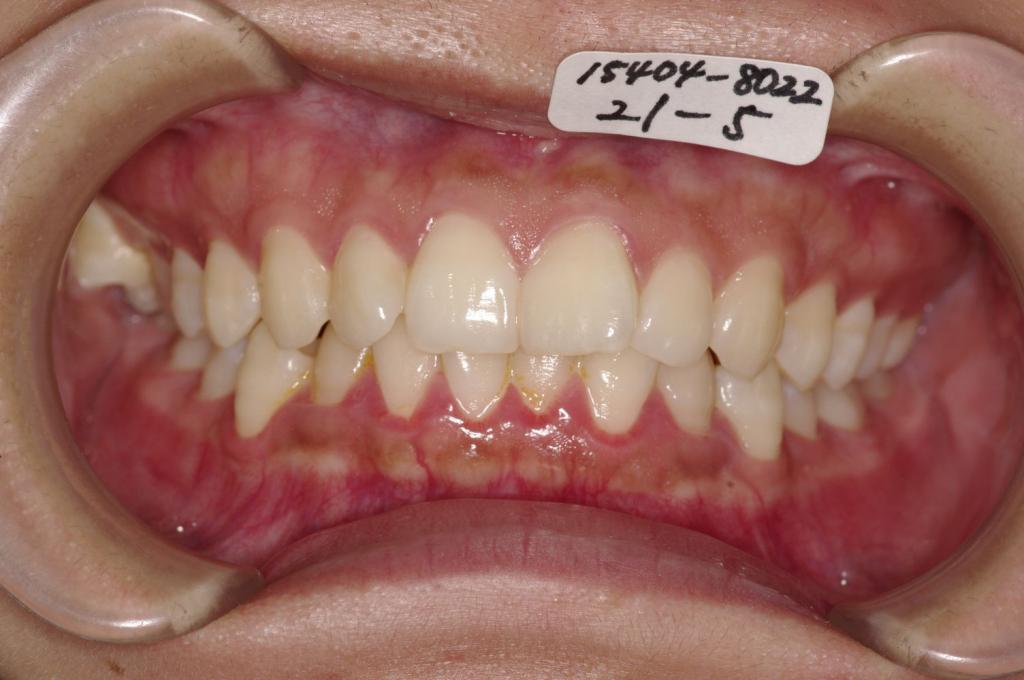 歯並び・咬み合わせ・八重歯・乱杭歯の矯正治療前口内写真NO.1122