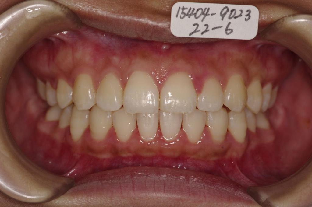 歯並び・咬み合わせ・八重歯・乱杭歯の矯正治療後口内写真NO.1122