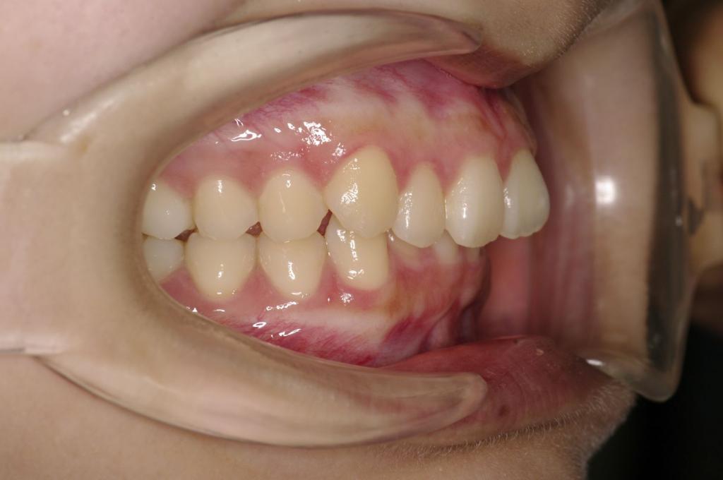 歯並び・咬み合わせ・八重歯・乱杭歯の矯正治療前口内写真NO.1123