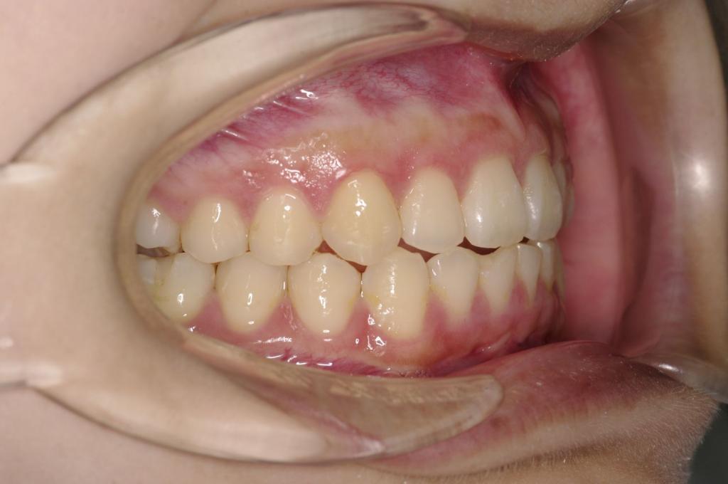 歯並び・咬み合わせ・八重歯・乱杭歯の矯正治療後口内写真NO.1123