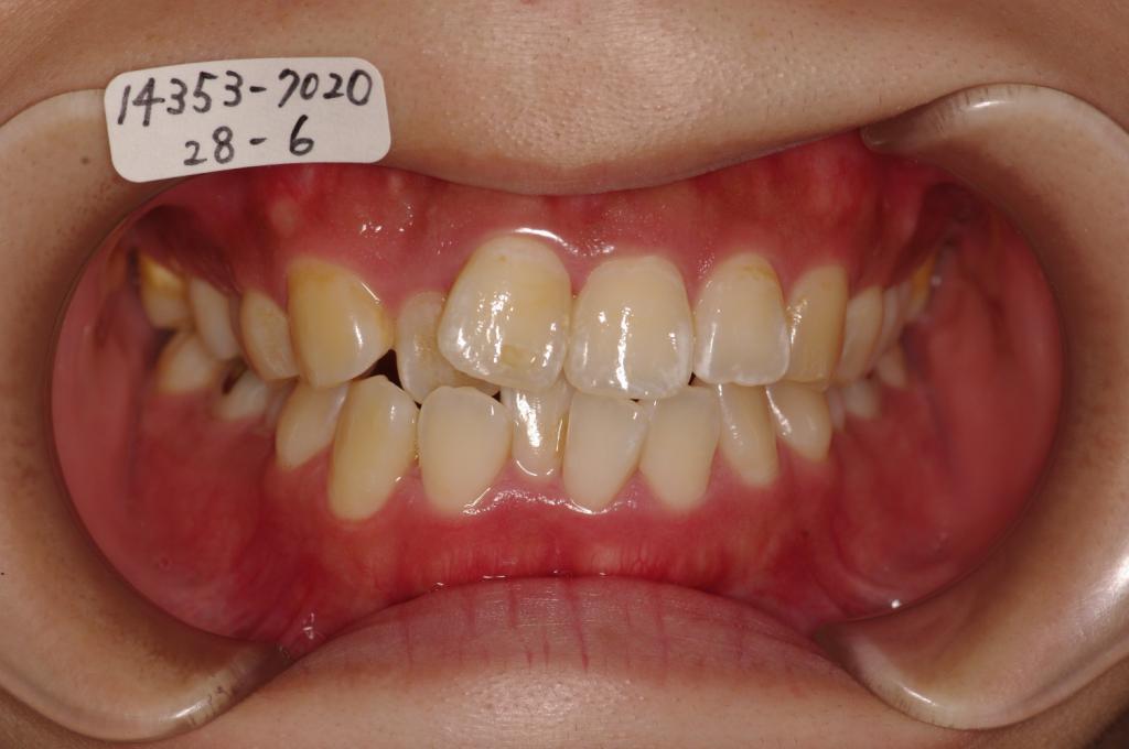 歯並び・咬み合わせ・八重歯・乱杭歯の矯正治療前口内写真NO.1124