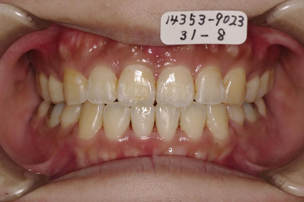 歯並び・咬み合わせ・八重歯・乱杭歯の矯正治療後口内写真NO.1124