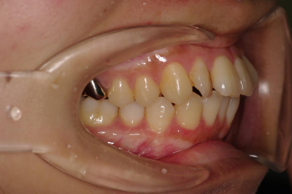歯並び・咬み合わせ・八重歯・乱杭歯の矯正治療前口内写真NO.1125