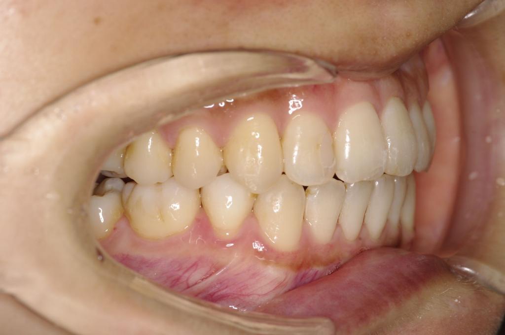 歯並び・咬み合わせ・八重歯・乱杭歯の矯正治療後口内写真NO.1125