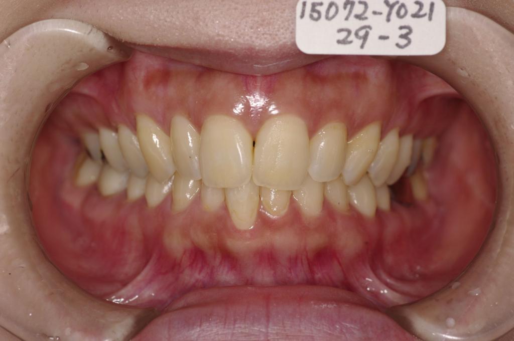 歯並び・咬み合わせ・八重歯・乱杭歯の矯正治療前口内写真NO.1126