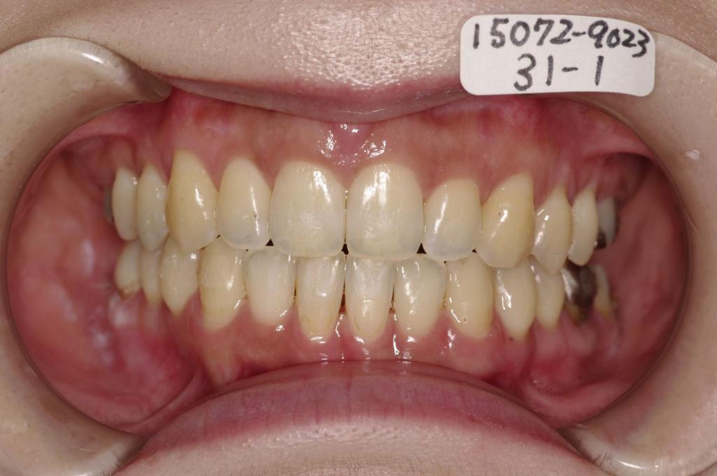 歯並び・咬み合わせ・八重歯・乱杭歯の矯正治療後口内写真NO.1126