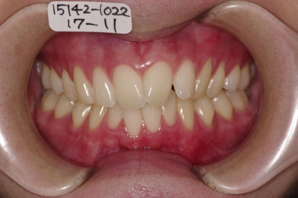 歯並び・咬み合わせ・八重歯・乱杭歯の矯正治療前口内写真NO.1127