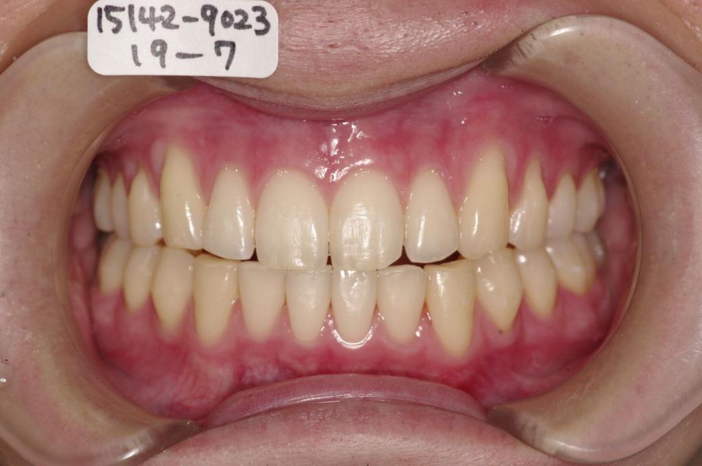 歯並び・咬み合わせ・八重歯・乱杭歯の矯正治療後口内写真NO.1127