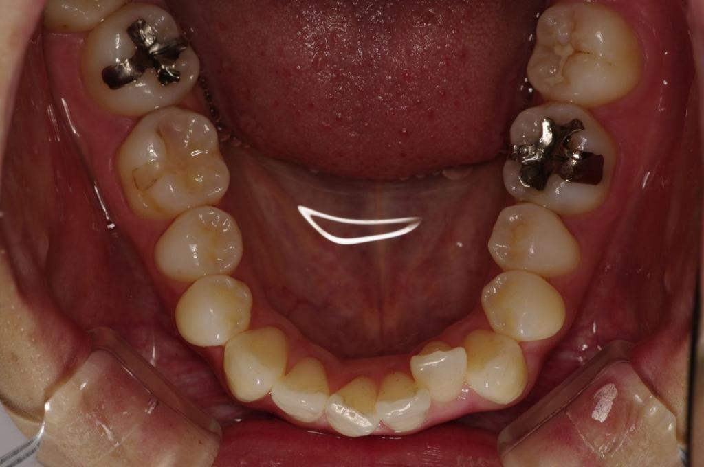歯並び・咬み合わせ・八重歯・乱杭歯の矯正治療前口内写真NO.1128