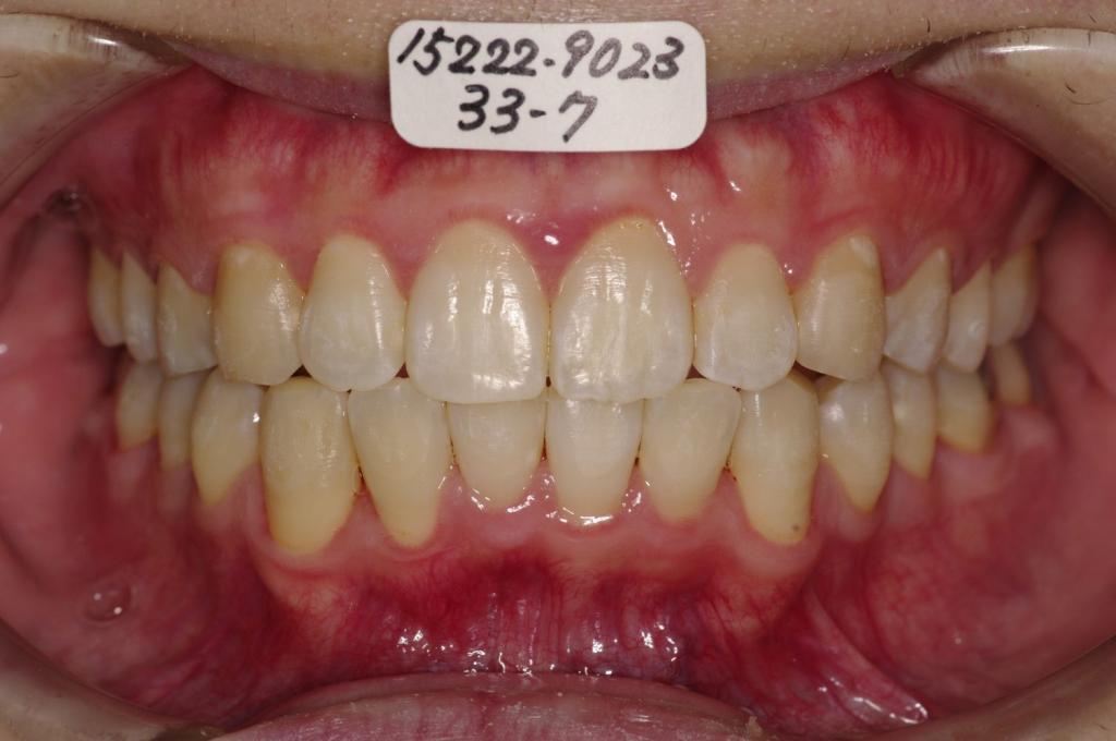 歯並び・咬み合わせ・八重歯・乱杭歯の矯正治療後口内写真NO.1129