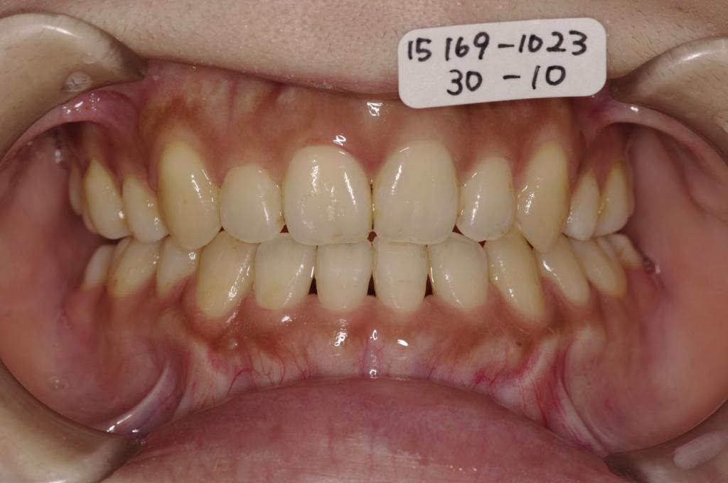 歯並び・咬み合わせ・八重歯・乱杭歯の矯正治療後口内写真NO.1130