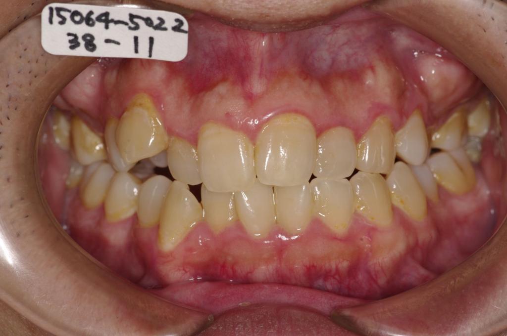 歯並び・咬み合わせ・八重歯・乱杭歯の矯正治療前口内写真NO.1131
